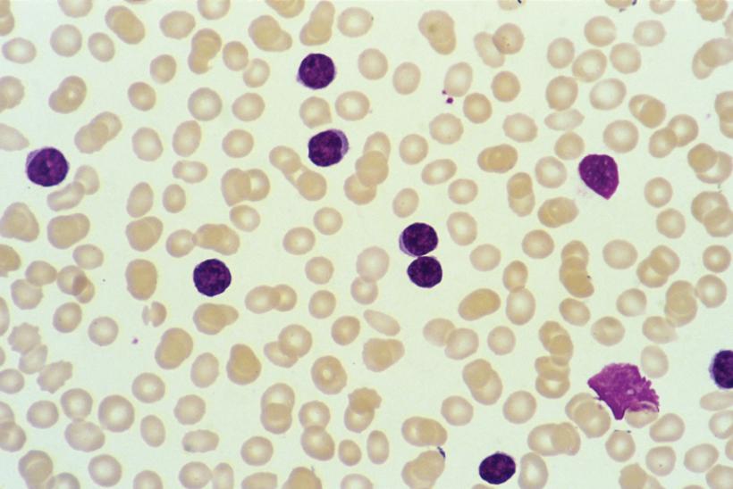 Leukaemia cells (purple)